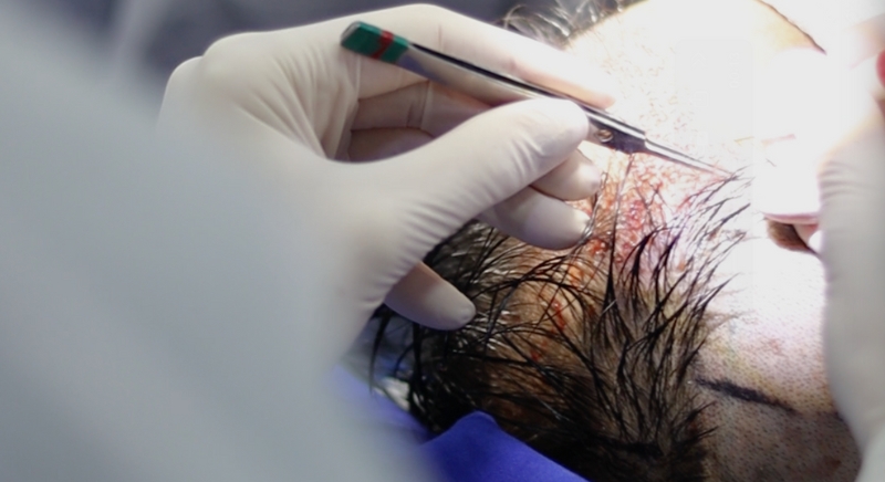 Como se Preparar para seu Transplante Capilar FUE: Dicas e Conselhos