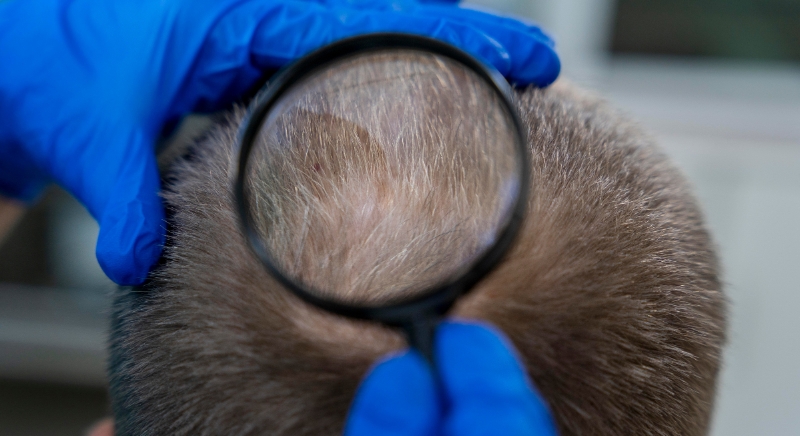 O que acontece no seu couro cabeludo após um transplante capilar?